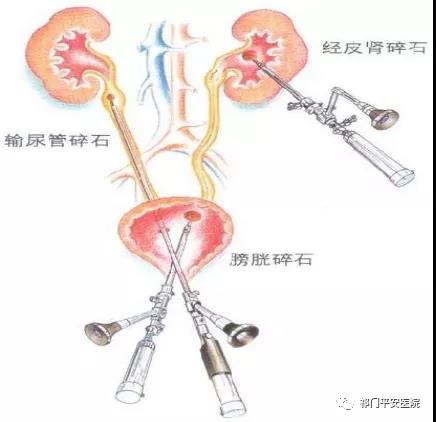 泌尿系结石微创手术 疏通尿路创伤小