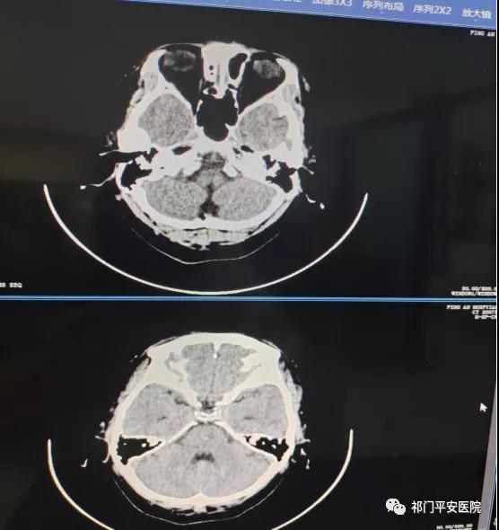 急性缺血性脑卒中磁共振检查的优势